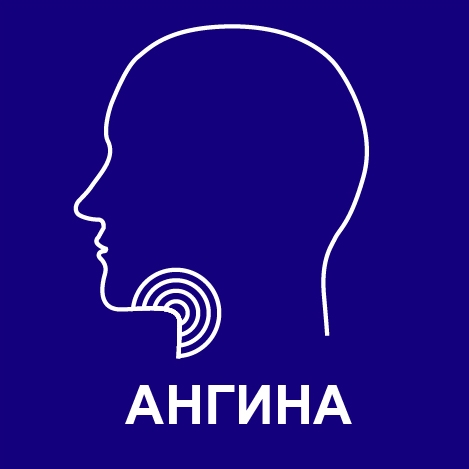 программа лечения ангины